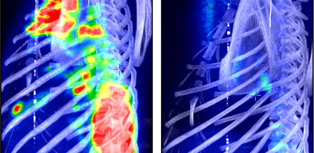 PET-CT