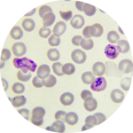 Malaria parasites in red blood cells