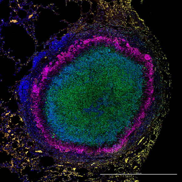 TB Granuloma